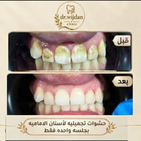 تجميل اسنان • دكتورة وجدان • دفع بالاقساط