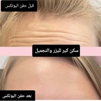 بوتوكس • بوتوكس التعرق • سكن كير