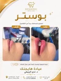 فيلر شفايف • هايجنك • الحريّة