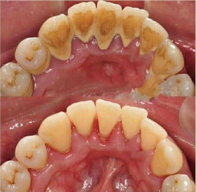 عروض الجمعه تنضيف أسنان ب20 فقط بدل 50 
الحجز على الرقم التالي ***********

نص مكتوب في الصور:
- Spudak dental group
