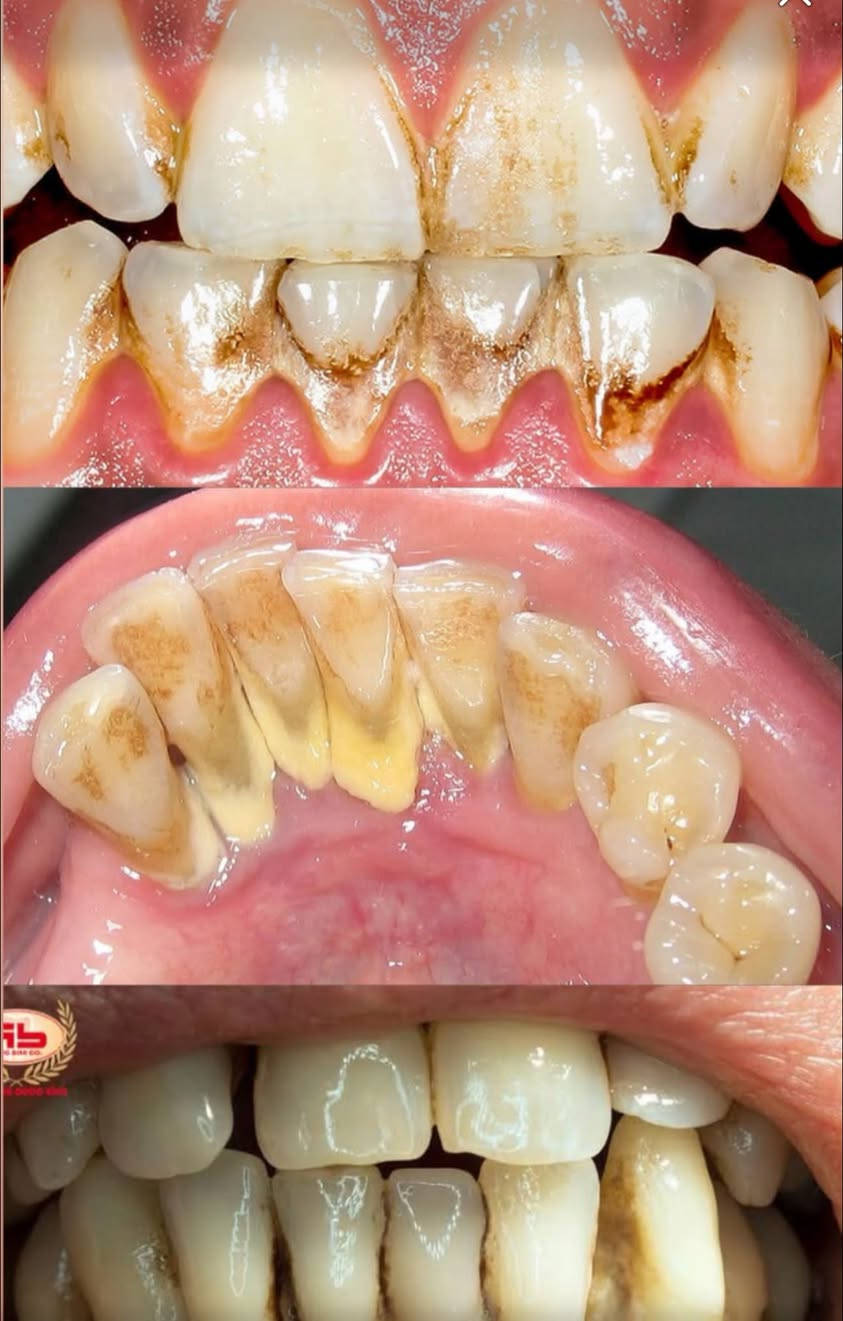 علاج مجاني • تنظيف اسنان • عيادات جامعه الكفيل