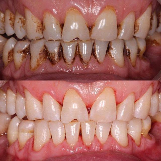الفحص والعلاج مجاناً 
وتحت إشراف دكاترة مختصين وباستخدام أحدث الأجهزة والتقنيات.
حشوات وقلع وتنظيف و تعويض الاسنان المفقودة 

📍 كربلاء – عيادات كلية الأمل
📍 قرب مستشفى الكفيل
📩 للمهتمين يرجى التواصل على الخاص وحجز موعدكم او واتساب  ***********

