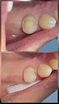 حشوه ضوئية • تجميلية • الاسكندريه