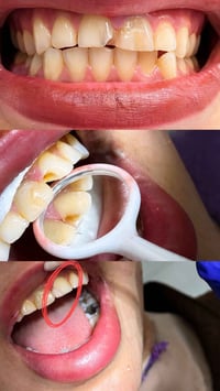 حشوات تجميلية • أسنان أمامية • مجانية