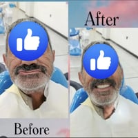 تعويض اسنان • مجاني • صور قبل بعد