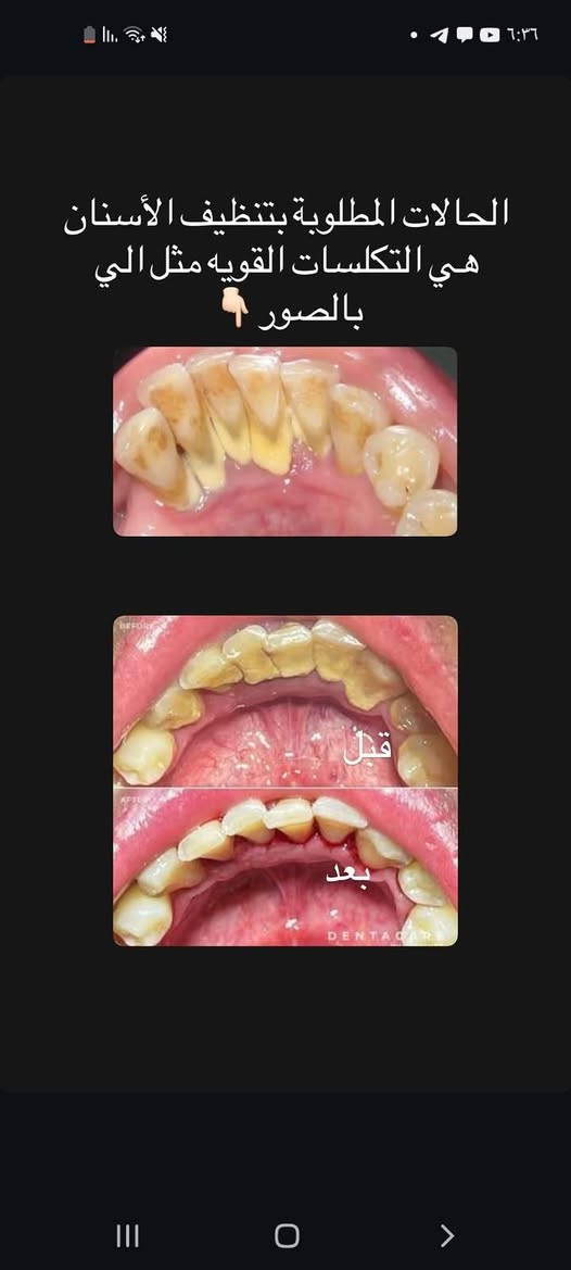 ​🦷 1_ حشوات الأسنان الدائمة الضوئية
🦷 2_ حشوات الجذور للأسنان الأمامية

​🦷 3_ تقويم أسنان متحرك

​🦷 4_ فحص وعلاج جميع حالات الأطفال

​🦷 5_ قلع الأسنان التالفة والجذور المتبقية

​🦷 6_ تنظيف الأسنان وإزالة التكلسات

​🦷 7_ تعويض الأسنان المفقودة بطقم متحرك كامل

​🦷 8_ تشخيص وعلاج الأمراض المتعلقة بالفم

​علماً العلاج مجاناً وتحت إشراف أطباء اختصاص

​📞 ***********

📍 بابل _ شارع 40 مجاور صيدلية سلامتك أولاً

​[ا

نص مكتوب في الصور:
- إذا عندكم ( طفل او بالغ ) هيج حالة تواصلوا وياي
- الحالات المطلوبة بتنظيف الأسنان هي التكلسات القويه مثل الي بالصور 👇🏻 قبل بعد
- تتوفر عيادة للأطفال لمعالجة الحالات المذكورة :
- تنظيف الأسنان و تطبيق الفلورايد لوقاية الأسنان من التسوس
- علاج تسوس الأسنان بالحشوات الدائمة
- قلع الأسنان
- اللي عنده هيج حالة ويريد يسوي أسنانه يتواصل ويايه اثبت اله حجز الاسبوع القادم ان شاء الله