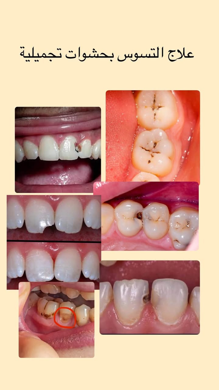 علاج مجاني • طقم جزئي • جامعة النور