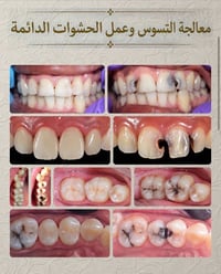 علاج مجاني • عيادات جامعة واسط • تنظيف وحشوات