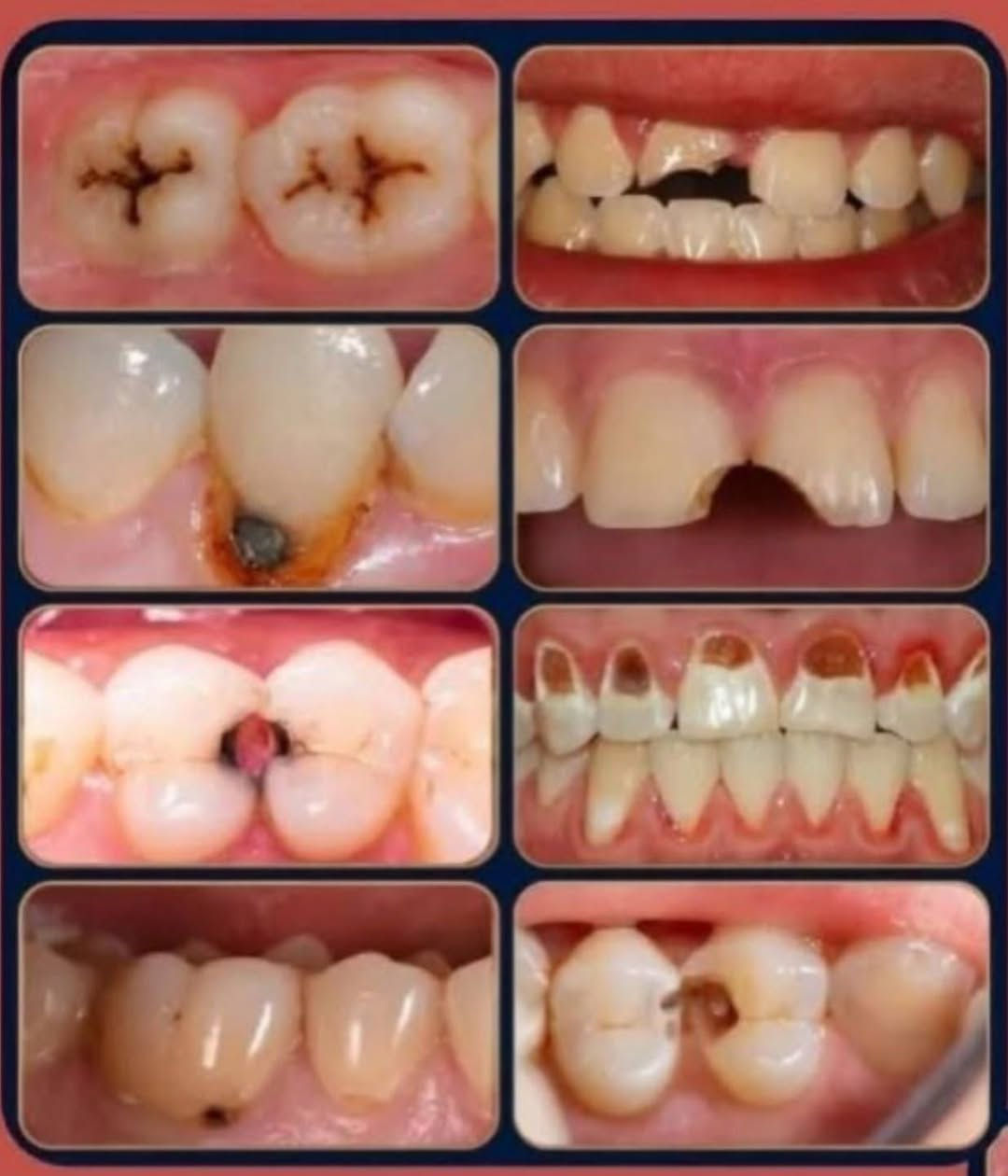 تسوسات • علاج مجاني • مراسلة