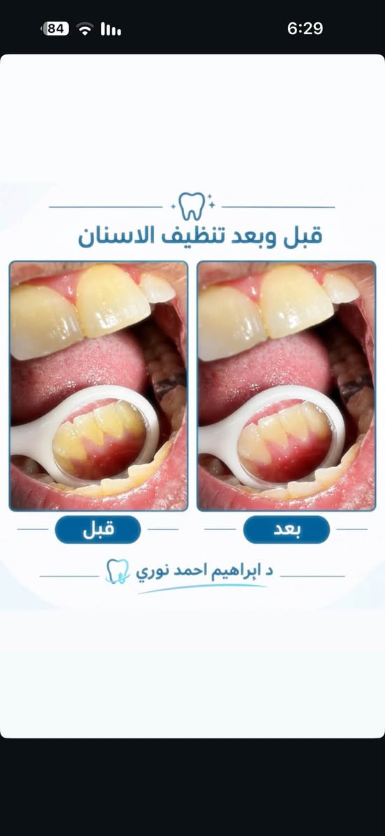 عيادات جامعة البيان • د.إبراهيم أحمد نوري • حشوات وتبييض