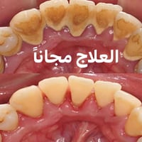 تكلسات • تنظيف أسنان • علاج مجاني