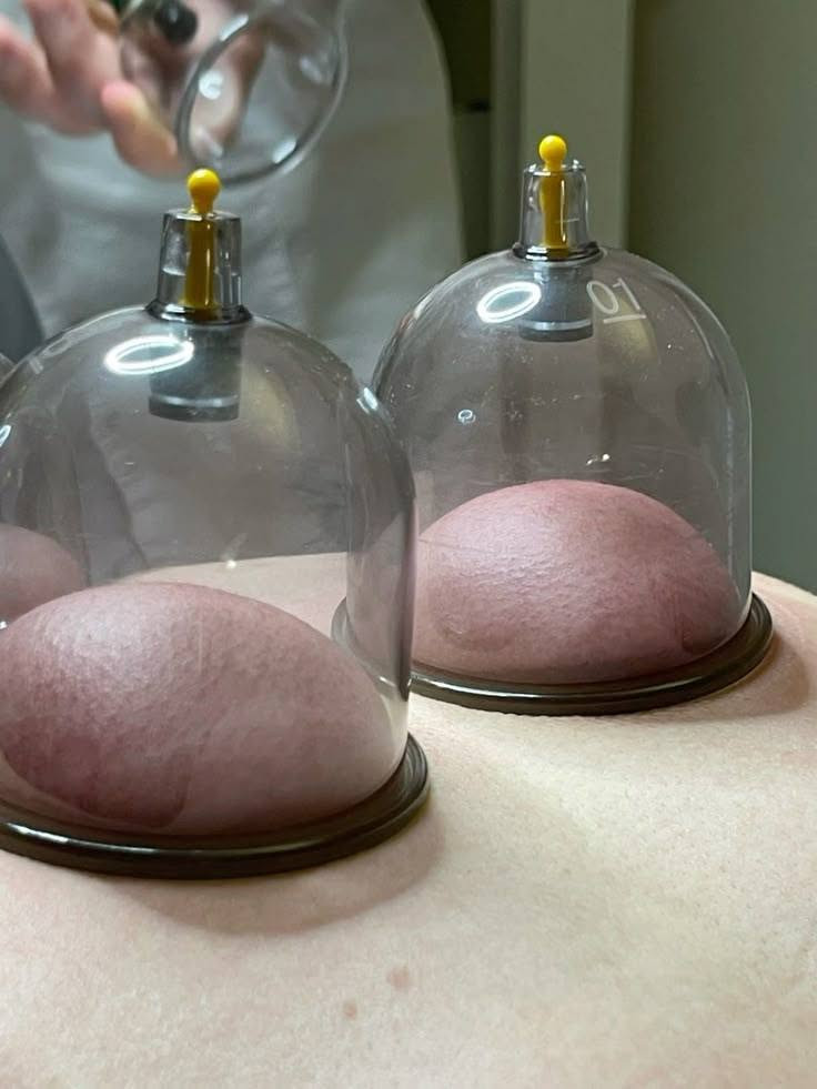 ✨ مساء الخير من حجامة الرحمة 🤍
ثلاث طرق مختلفة للعناية بالجسم… فما الفرق بينها؟
الحجامة الرطبة، الحجامة الجافة، والمساج… تعرّفوا على كل نوع ومتى يُستخدم 🌿

🩸 أولاً: الحجامة الرطبة
هي الحجامة التي يتم فيها استخدام الكؤوس مع تشريط سطحي بسيط للجلد وسحب كمية محدودة من الدم، وتُجرى وفق إجراءات النظافة والتعقيم.

قد تُستخدم كنوع من الطب التكميلي للمساعدة على الاسترخاء وتخفيف بعض الآلام والشد العضلي، ويُفضّل تحديد مدى ملاءمتها لكل شخص حسب حالته الصحية.
⚠️ لا تُجرى فوق الأورام أو في الحالات التي تمنع فيها طبيًا.

⭕ ثانياً: الحجامة الجافة
وهي استخدام كؤوس الهواء دون تشريط للجلد، وتُستخدم بشكل شائع للمساعدة على:
• تخفيف التشنجات والشد العضلي
• الاسترخاء وتحسين الإحساس بالراحة
• المساعدة في الاستشفاء العضلي بعد المجهود
• تخفيف بعض الآلام العضلية

💆🏻‍♀️ ثالثاً: المساج
جلسات المساج تساعد على إرخاء العضلات وتقليل التشنج، ويمكن أن تُستخدم ضمن برامج العلاج الطبيعي لبعض حالات الفقرات والشد العضلي، مثل منطقة الفقرات العنقية والقطنية، بحسب تقييم المختص.

🌿 نختار نوع الجلسة بما يتناسب مع احتياج كل شخص وحالته الصحية.

🤍 حجامة الرحمة للنساء والرجال
📱 Instagram: hijama._clinic
☎️ ***********

أهلاً وسهلاً بكم دائمًا 🌷
