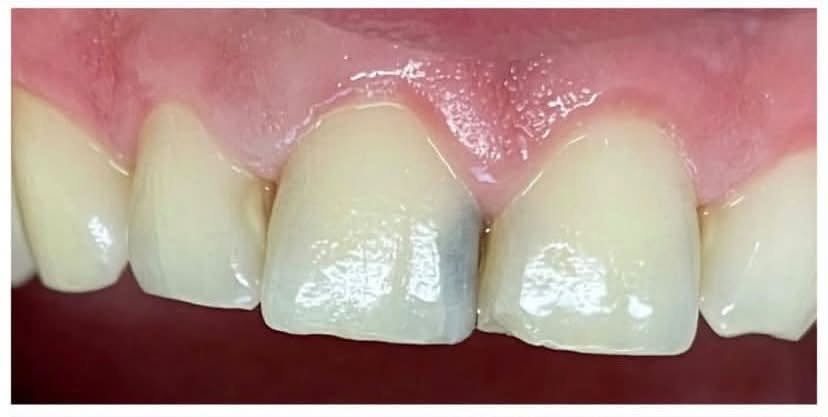 السلام عليكم 🌷🦷
حاليًا أستقبل بعض الحالات لعلاج الأسنان بشكل مجاني ، واللي يحتاج علاج أو يعرف أحد محتاج يراسلني خاص حتى أشوف الحالة وأوضح التفاصيل.

الحالات اللي أشتغل عليها حاليًا للكبار او الاطفال :
• حشوات الأسنان (حشوه بيضاء بلون السن بجلسه واحده)
• تنظيف وعلاج اللثة 
• قلع الأسنان والجذور التالفه
• تعويض الاسنان بطقم متحرك 
• العلاج بماده الفلورايد والسيلر لاسنان الاطفال
• وبعض الحالات الأخرى حسب الحالة

📍 المكان: [بابل طريق حله نجف عيادات جامعه المستقبل]
📩 للتفاصيل والحجز مراسلتي خاص.
     او واتساب ***********

الصور الي جوه توضيحيه مو تشوفوهن وتشردون🌚😂

نص مكتوب في الصور:
- تقويم الأسنان تعويض الأسنان بطقم متحرك حشوات تجميلية العلاج مجاني في بابل قلع الأسنان علاج أسنان الأطفال حشوات قلع العلاج الوقائي لأسنان الأطفال بالفلورايد والسيلر تنظيف الأسنان أسنان صحية ابتسامة أجمل مستقبل أفضل Small steps Big smiles Dentistry Oral Health Better Smiles
