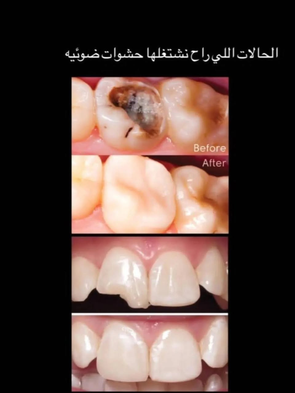 مرحـبًا ، اي احد منكم او اهلكم محتاج معالجة لاسنانهم ، تـوجد عيادات مـجانية في جامعة المصطفى -شارع فـلسطين الموال -قرب الجامعة المستنصرية
مرحـبًا ، اي احد منكم او اهلكم محتاج معالجة لاسنانهم ، تـوجد عيادات مـجانية في جامعة المصطفى -شارع فـلسطين الموال -قرب الجامعة المستنصرية 

-حشوات ضوئية 
-قلع الأسنان و بقايا الجذور
-تنظيف الأسنان و إزالة التصبغات و التكلسات
-تعويض الأسنان بالطقم الجزئي المتحرك 
عـلمًا ان العمل تحت اشراف اطباء اختصاص ، للحجز التواصل عن طريق الحساب او واتساب عن طريق الرقم ‭***********‬

نص مكتوب في الصور:
- balm dentist طبيبة أسنان حشوات ضوئية قلع الأسنان و بقايا الجذور تنظيف الأسنان و إزالة التصبغات و التَكلسات تعويض الأسنان بالطقم الجزئي المتحرك عيادات جامعة المصطفى - شارع فلسطين قرب الجامعة المستنصرية
- تنظيف الاسنان من التصبغات والتكلسات
- الحالات اللي راح نشتغلها حشوات ضوئيه Before After
- قلع الأسنان وبقايا الأسنان 🦷
- تعويض الاسنان المفقوده بتركيب جزئي متحرك 🦷
- Before
- After