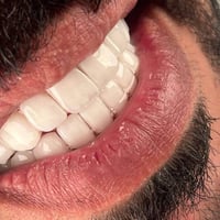 زراعة الاسنان • تبييض الاسنان • الحسينية بغداد