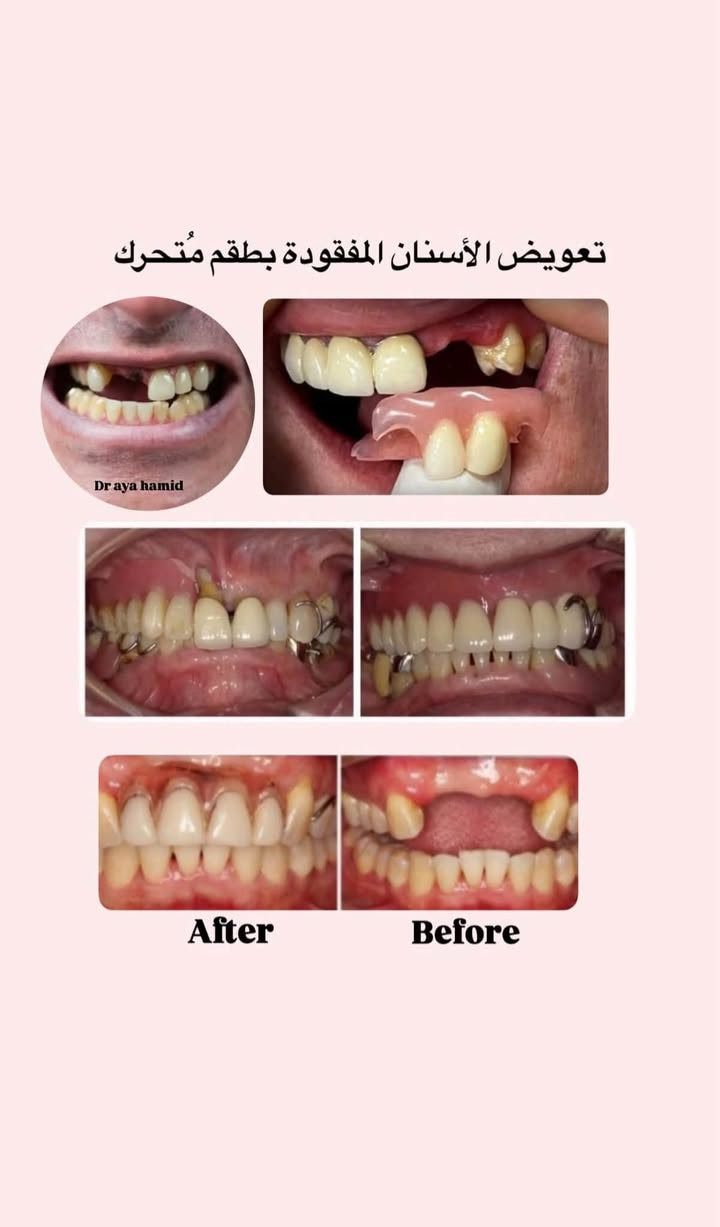 مجاناً مجاناً
السلام عليكم
انا طالبة طب اسنان اللي يحتاج
1. قلع للاسنان
﻿﻿﻿حشوات بيضاء تجميلية
﻿﻿﻿أطخم أسنان متحركة للاسنان المفقودة
﻿﻿﻿تنظيف للاسنان
خدمة مجاني بعيادة كلية النور الجامعة بحي الشلالات مقابل دجلة ستي
للتواصل عالواتس ***********
او علقو حسب حالتكم وانا اتواصل معاكم.

نص مكتوب في الصور:
- علاج التسوس بحشوات ( بيضاء ) تجميلية
- Dr aya hamid
- تنظيف الأسنان وإزالة التكلسات
- قلع الأسنان التالفة
- تعويض الأسنان المفقودة بطقم متحرك
- After
- Before