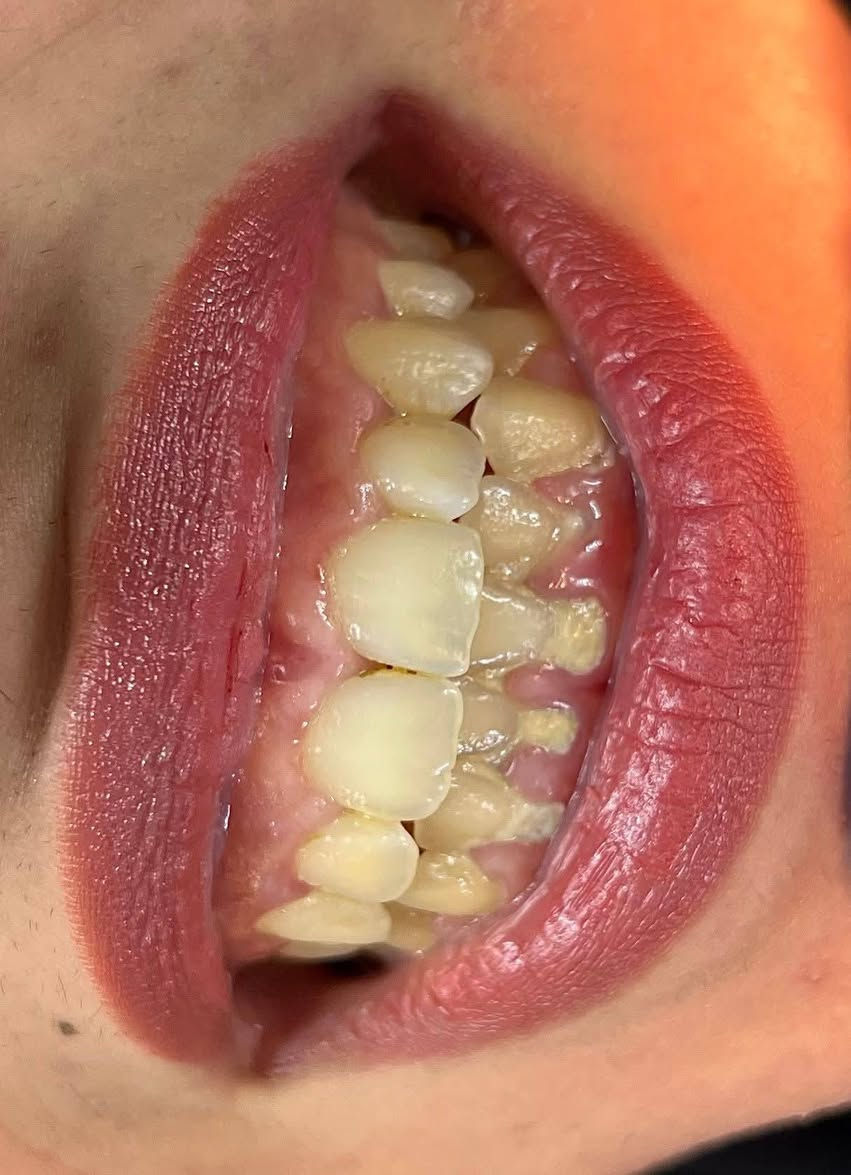 عروض الاسنان يمنه غير والي من طرفي اله خصم خاص من العياده
عيادة ألبيت ألطبي 
🦷 تنظيف وتلميع الأسنان
بدل 25 ألف
صار فقط ٢٠ ألف ✨

🦷 الحشوات الضوئية الدائمية
بدل 50 ألف
صار فقط 30 ألف 😍

🦷 تركيبات الزركون الثابتة
بدل 125 ألف
صار فقط 85 ألف 💎

🦷 تركيبات السيراميك
بدل 100 ألف
صار فقط 70 ألف 🔥

والفحص والمعاينة مجاني
✅ أفضل المواد والأجهزة الحديثة
✅ شغل تجميلي طبيعي ومضمون
✅ أسعار وعروض لفترة محدودة
✅ ابتسامة مرتبة بأقل تكلفة
📍 المحمودية – حي الموظفين – مقابل التانكي
🦷 بكج تنظيف + تلميع + تبييض الأسنان 🤍
تخلّص من التصبغات وتراكمات الأسنان، واسترجع نظافة ولمعان ابتسامتك 
🔥 بكج متكامل بسعر مميز ولفترة محدودة!
✔️ إزالة التكلسات
✔️ تنظيف وتلميع الأسنان
✔️ تبييض الأسنان
✔️ ابتسامة أنظف وأجمل ✨
📍 عيادة البيت الطبي
📞 للحجز والاستفسار: ***********
📲 الحجز متوفر عبر الواتساب

لا تخلي ابتسامتك تنتظر… احجز موعدك الآن �
