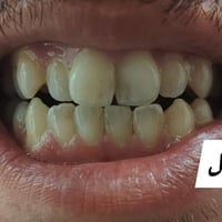 نتيجة بعد ٣ جلسات • جلسة كل شهر • مشيرفة الأولى