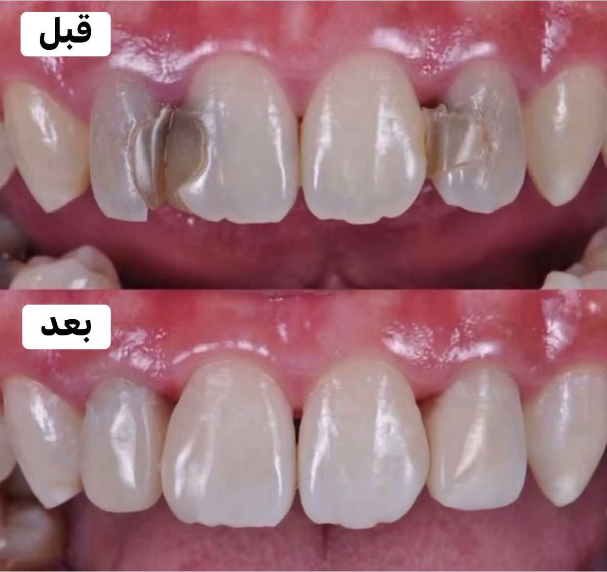 مجاني • عيادات جامعة الفارابي • حشوات/تبيض/قلع
