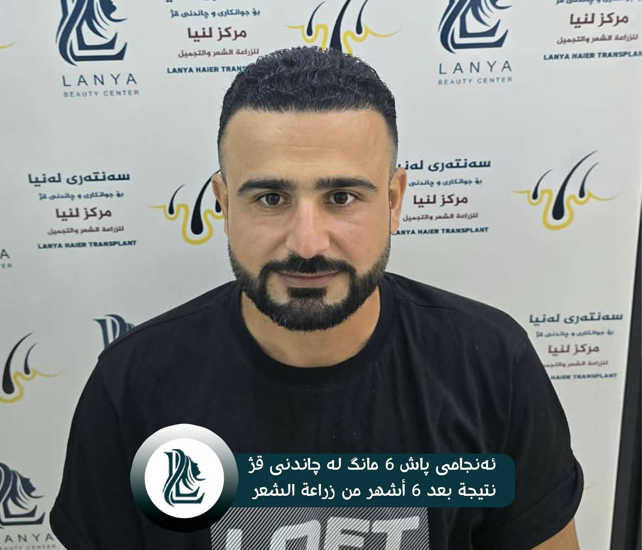 استعد كثافة شعرك من جديد! 
في مركز لەنيا للتجميل و زراعة الشعر ، نساعدك على استعادة مظهر الشعر الطبيعي والأكثر كثافة من خلال زراعة الشعر.
🌿 نتائج طبيعية | 👨‍⚕️ خبرة واحترافية | ✨ عناية بأدق التفاصيل
لەنيا — لأن جمالك يستحق الأفضل. 🤍
♦ مع لەنیا حافظ على شبابك.
📍 العنوان:كلار - شارع ليوا - قرب جامع بخاري
📞 رقم التواصل:
***********
--------
قژێکی پڕتر، متمانەیەکی زیاتر! 
لە سەنتەری جوانکاری لەنیا، بە چاندنی قژ هەنگاوێک بەرەو قژێکی جوانتر و سروشتی‌تر بنێ.
🌿 ئەنجامی سروشتی | 👨‍⚕️ پسپۆڕی | ✨ گرنگیدان بە وردەکاری
♦ لەگەڵ لەنیا هەمیشە بەگەنجی دەمێنێتەوە
📍 ناونیشان: کەلار- شەقامى لیواکە - نزیک مزگەوتی بوخاری
📞 ژمارەی پەیوەندی: ***********
