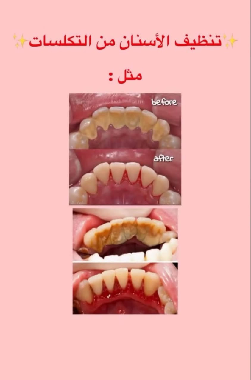 جامعة الكوفة عيادات طب الاسنان
‎السلام علیکم

‎قلع الاسنان التالفه وبقايا الجذور وتعويضها بطقم اسنان

‎حشوات دائمية ضوئية للكبار والاطفال

‎تنظيف الاسنان من التكلسات والتصبغات

‎علماً العلاج مجاناً وتحت اشراف اطباء مختصين الموقع / عيادات جامعة الكوفة خلف كلية الفقه للحجز والاستفسار دايركت

‎*********** واتساب

نص مكتوب في الصور:
- تعويض الأسنان المفقودة بطقم كامل
- تنظيف الأسنان من التكلسات
- مثل :
- before
- after
- العنده هيج تسوس نكدر نعالجهم بحشوات ضوئية ON THIS DAY العلاج مجاناً