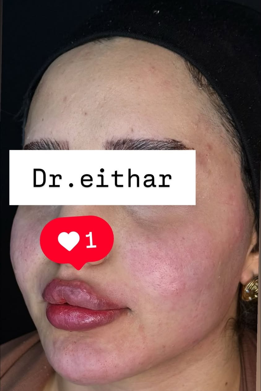 كونتور الوجه بالفلر  (لفتنك وجنات  واصداغ وتدوير الفك والذقن ونظاره وشفة تعديل ع حقن سابق للشفة) 🔥🔥
لاحضو الفرق بالذقن ومنطقه الفك   شكد تغير الشكل🔥
عروووض للكادر التدريسي والخريجات والموظفات والعروسات  ثبتتهه الكم بالستوري بالهايلايت وببوست اعلى الصفحة ✨✨

د.ايثار سامي عبد الامير
واسط الكوت الهوره مجمع القبطان طابق اول 

الحجز***********

نص مكتوب في الصور:
- Dr.eithar 1