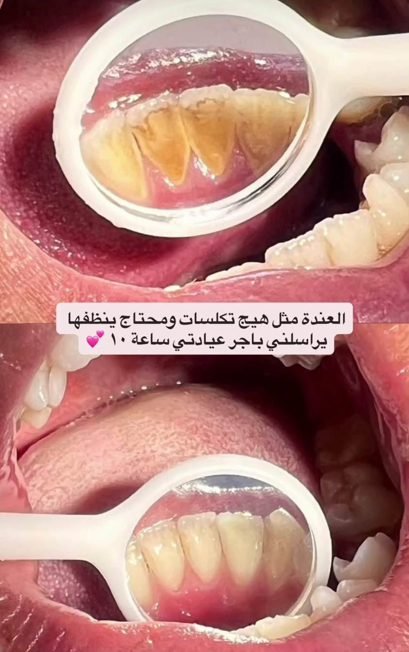 حشوه • تنضيف اسنان • مجاني