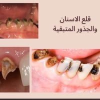 قلع مجاني • جذور متبقية • كلية طب الأسنان ذي قار