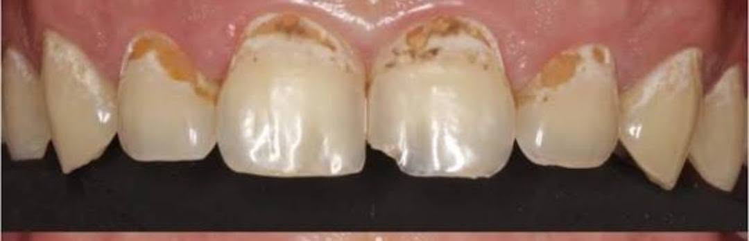 🦷 حشوات أسنان مجانية 🤍

أي شخص محتاج حشوة أسنان مجاناً، باچر متوفر علاج الساعة 12 ظهراً.

📍 الجمعية – خلف مول الحارث

 التواصل على الخاص أو على الرقم:
📞 ***********
