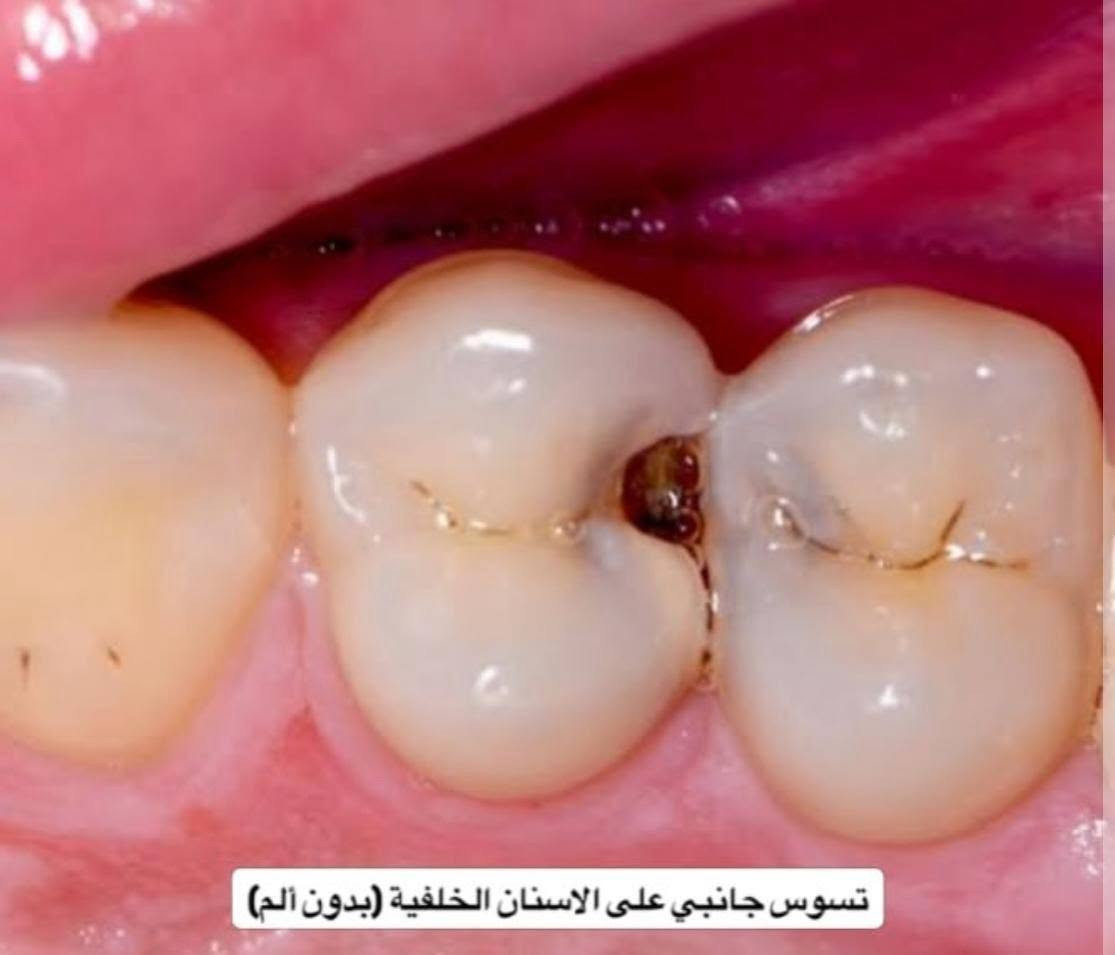 علاج مجاني • تنظيف اسنان • تسوس جانبي