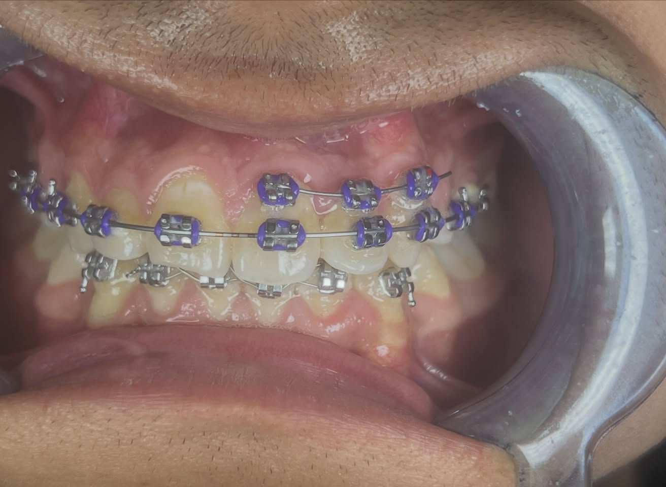 التقويم يميزنا احد اعقد و اصعب الحالات عدم انتظام و ازدحام شديد في ترتيب الاسنان ماشالله الوصول الى مراحل شبه نهائية الصور تتكلم …. علاج جميع الحالات الصعبة و المعقدة نتائج مضمونة خبرة طويلة في مجال الحالات المعقدة دقة طبية في التعامل ابتسامة مثاليه اسعار مناسبة بالتقسيط المريح… دكتور غزوان مزهر بغداد الكرخ نفق الشرطة بداية شارع الاطباء عيادة لوركا فوق صيدلية كنز النفق متوفر واتس *********** #تقويم_الاسنان #تقدم_الفك_السفلي #تقويم_الشفاف #تقويم_الدايمون #زراعة_الاسنان @تغليف_الاسنان_الزاركون
