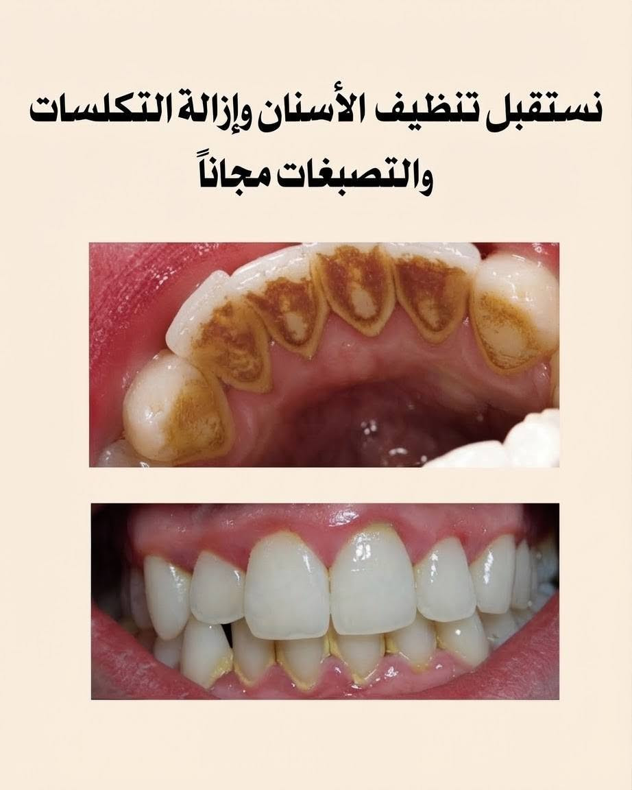 السلام عليكم
اني طالبة طب أسنان مرحلة رابعة
 
اشتغل عدة حالات مثل: 

• حشوات تجميلية 
• تنظيف أسنان وإزالة التكلسات والتصبغات
• قلع الأسنان والجذور المتبقية
• تعويض الأسنان بطقم جزئي متحرك

وأكيد العلاج مجاني وتحت إشراف أطباء أختصاص 

إذا عندك أي حالة من الحالات المذكورة بالبوست، صوّر الحالة ودز الصورة على الواتساب، حتى نقيم الحالة ونحدد موعد العيادة بإذن الله 🦷🥼

عنواني : جامعة الرافدين - بغداد - حي القاهرة - قرب الرعاية الأجتماعية 

رقم الواتساب: 
‎***********

نص مكتوب في الصور:
- رعاية كاملة لأسنانك جامعة الرافدين / بغداد / حي القاهرة دكتورة زهراء جاسم حشوات ضوئية "تجميلية" قلع الأسنان والجذور المتبقية تعويض الأسنان بطقم جزئي متحرك تنظيف الأسنان وإزالة التكلساك العلاج مجانا وتحت إشراف أطباء أختصاص للحجز وللاستفسار ارسل صورة للحالة على الواتساب *********** @dr.zahraa_j
- نستقبل حشوات ضوئية " تجميلية " مجاناً
- نستقبل تنظيف الأسنان وإزالة التكلسات والتصبغات مجاناً
- نستقبل قلع الأسنان والجذور المتبقية مجاناً
- تعويض الأسنان المفقودة بطقم جزئي متحرك مجاناً
- بعد
- قبل