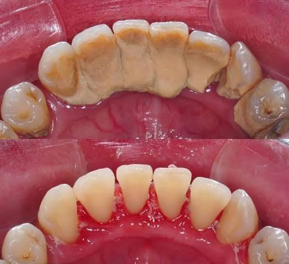 تنضيف أسنان • علاج مجاني • واتساب
