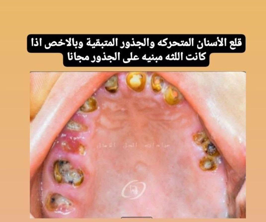 مجانا • قلع جذور • طقم متحرك