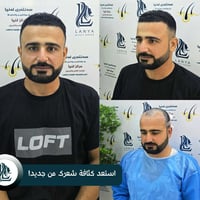 زراعة شعر • نتائج طبيعية • كلار ليوا