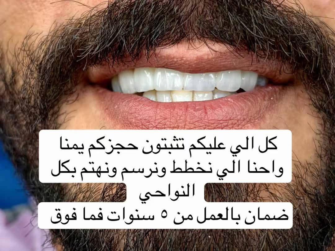 بس  ثبّتوا حجزكم ويانا 😍🔥

والباقي خلّوه علينا!
نخطط، نرسم، ونهتم بكل التفاصيل حتى نطلعلكم ابتسامة تفرحون بيها كل يوم 🤍🦷

وشغلنا عليه ضمان من ٥ سنوات وفوك

كادر متخصص متواجد يوميا من ساعة ٤-٩ 
تنورونا دائما 

#اكسبلور #explore #الشعب_الصيني_ماله_حل😂😂

نص مكتوب في الصور:
- الابتسامة يمنا غير شكل مو بس قالب ونثبته الابتسامة يمنا تفاصيل وشفافية وجمالية تخلي ثقتك بنفسك تزيد كل يوم الزاركون المدمج بالايماكس ب ٩٠ الف فقط للسن الواحد الزاركون ب ٧٠ الف للسن الواحد ***********
- كل الي عليكم تثبتون حجزكم يمنا واحنا الي نخطط ونرسم ونهتم بكل النواحي ضمان بالعمل من 5 سنوات فما فوق