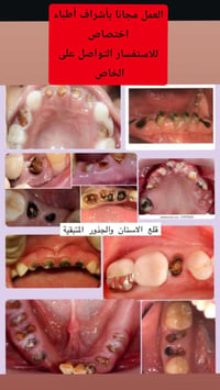 قلع مجاني • الثلاثاء • أطباء اختصاص