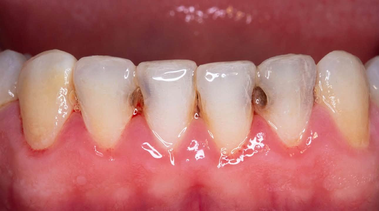 علاج مجاني بالكامل ‼️
لحالات التسوس بالحشوات التجميلية
قلع الجذور التالفة
تنظيف الاسنان من التكلسات و التصبغات 
تعويض الاسنان المفقودة بطقم متحرك 
العنوان: 
عيادات جامعة الهادي/ نهاية شارع 60
التواصل على الرقم 
***********
