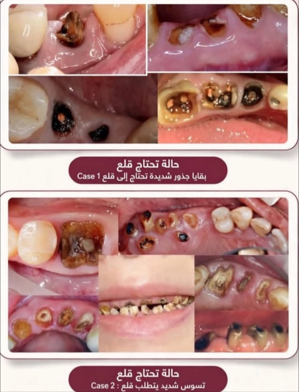 متوفر غدا الساعة 12:30 ظهرا
قلع الأسنان التالفة وبقايا الجذور
علما ان العلاج مجاني وتحت اشراف كادر متخصص
العنوان : جامعة اشور شارع مطار المثنى بالقرب من المنصور
للتواصل :
*********** واتس

نص مكتوب في الصور:
- حالة تحتاج قلع بقايا جذور شديدة تحتاج إلى قلع Case 1 حالة تحتاج قلع تسوس شديد يتطلب قلع : Case 2