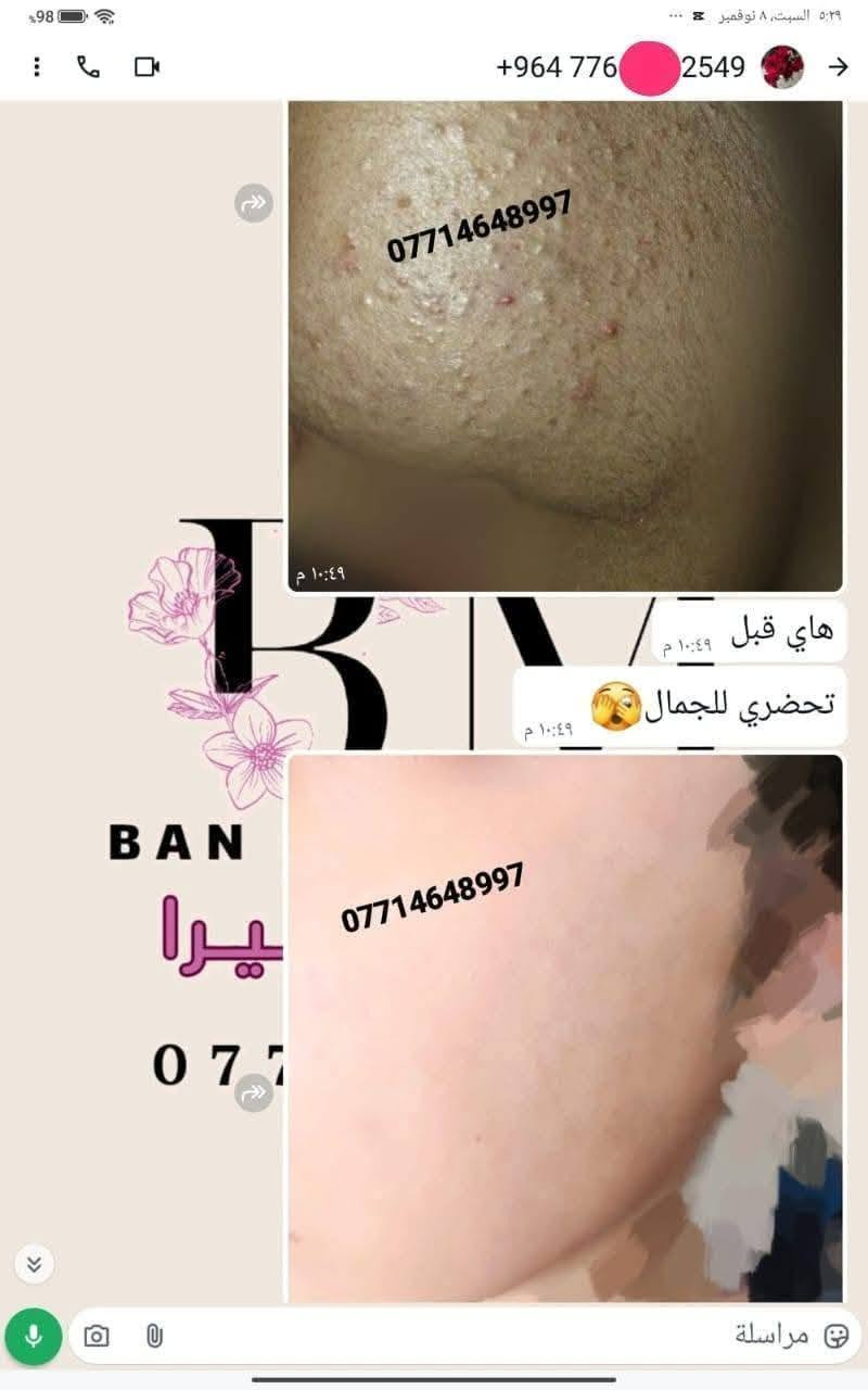 مع بكج العنبر المتكامل ماكو مستحيل 💪 منتجاتي الي اثبتت جدارته 🫶🏻ربي لك الحمد 🤲
عنوانه الثقه وتجاربنا تشهد  🫶 
انتبهو على تجارب كولهن بالارقام الهاتف  افتحو الصوره 
احبكم واحب تجاربكم

نص مكتوب في الصور:
- ***********
- علا اوليفيرا
- +964 773 8997
- معاد توجيهها
- بنان
- 07714
- OLA
- والله منتج يجن جاب نتيجه
- مراسلة
- علا اوليفيرا فرع ميسان
- *********** *********** علا اوليفيرا
- +964 782 280
- ۳ مرات بلسبوع تخلين فقط على بصله الشعر ولازم ينغسل ورا ما يبقى على شعر مده ٣ ساعات او ٤
- ١١:٣٥ م
- يصيرن 35 ١١:٣٦ م
- اكلج حبي وقبل سنه اختي اخدت منج زيت مدري شنو للشعر شنو للعسم مال الجسم
- ١١:٣٧ م
- وهسه ما عدهه شعر جسمهه صار خفيف كلش
- عندج منه
- 077
- OL
- ووجعي يدعيلج عل هل خلطه الحلوه والله اكعد من النوم منوره
- ١١:٣٩ م
- عود بعدني ما حافه
- علا اوليفيرا فرع ميسان ***********
- +964 776 2549 *********** هاي قبل تحضري للجمال *********** BAN يرا 077
- +964 776 2591 الله يعافيج بعد روحي ٥:٢٨ م طمنيني اخذتي صوره قبل وبعد الاستخدام ٥:٢٨ م هاا وصورت الج لان جنت ما صدكه ٥:٢٩ م علا اوليفيرا شوفي الكلوب عد بعضهاا ٥:٣٠ م *********** ٥:٣٠ م شوفي شلون جان مدمر الحنج ٥:٣١ م *********** ٥:٣٢ م صلاوات على محمد شوفت عينج ٥:٣٢ م مراسلة
- +964 786 7121 *********** علا اوليفيرا B A N كيمرر علا اوليفيرا والمسمن بديت بي قبل جم يومم خلاني شكد اكل اهلا وسهلا يقلبي ماشاءالله