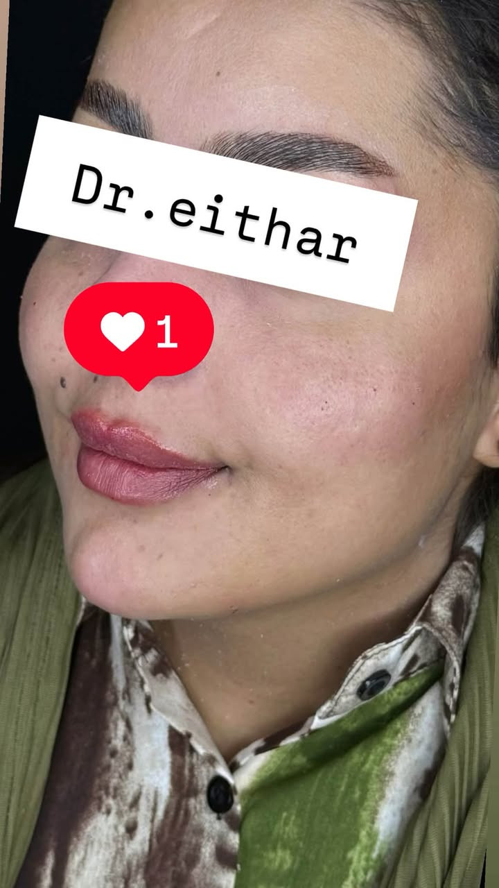 تجديد حقن للمره الثالثه كل سنه نجدد بالفلر السويسري. كونتور الوجه بالفلر  (لفتنك وجنات  واصداغ وتدوير الفك والذقن ونظاره وشفة و ) 🔥🔥🔥
عروووض للكادر التدريسي والخريجات والموظفات والعروسات  ثبتتهه الكم بالستوري بالهايلايت وببوست اعلى الصفحة ✨✨

د.ايثار سامي عبد الامير
واسط الكوت الهوره مجمع القبطان طابق اول 

الحجز***********

نص مكتوب في الصور:
- Dr.eithar 1
- Dr.eithar
- 1