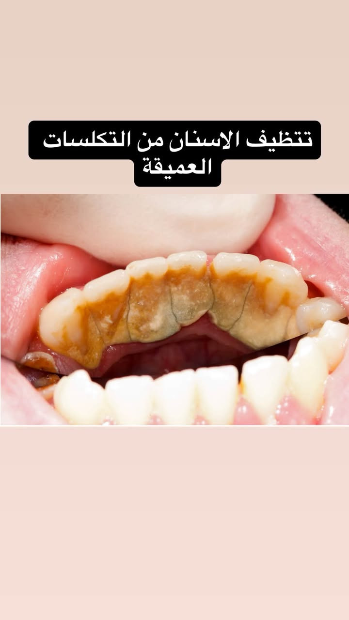 السلام عليكم العلاج مجاني بالكامل تحت اشراف اطباء مختصين
تتوفر ايضاً زرعات الاسنان باسعار مناسبة
الي يحب يتفضل يتواصل ويايه واتس اب 

‭+٩٦٤ ٧٨٣ ٨٧٩ ٨١٧٤‬

نص مكتوب في الصور:
- Dr. Elaph Hafid
- الدكتورة إيلاف حافظ
- قلع الأسنان والجذور التالفة وسن العقل
- تنظيف الأسنان وازالة التكلسات
- معالجة التسوس بحشوات ضوئية للأسنان
- تعويض الأسنان المفقودة بطقم متحرك جزئي وكامل
- تقويم الاسنان
- حشوات الجذور
- معالجة أسنان الأطفال
- عيادات جامعة البيان/شارع مطار بغداد الدولي/قرب ساحة عباس ابن فرناس
- العلاج مجاني بالكامل تحت اشراف اطباء مختصين
- ***********
- معالجة اسنان الاطفال
- تعويض الاسنان المفقوده بطقم جزئي وكامل
- قلع الاسنان والجذور التالفة وسن العقل
- تنظيف الاسنان من التكلسات العميقة