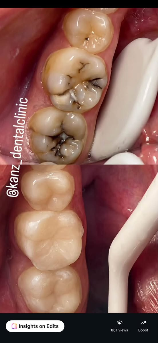ننتضركم يوميا في عيادة كنز الابتسامه من الساعه ٥ للساعه ٩ مساءا للحجز والاستفسار واتس *********** عنوان العيادة نزلة گميره فوق صيدليه ليث صباح مقابل علوة ابو محمد
