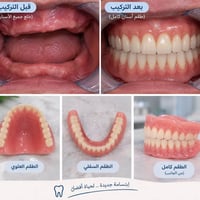 طقم أسنان مجاني • كبار السن • بعقوبة ديالى