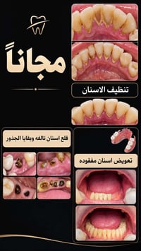 علاج مجاني • قلع جذور • طقم اسنان