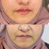 حقن شفه • خطوط ضاحكة • تقسيط ماستر