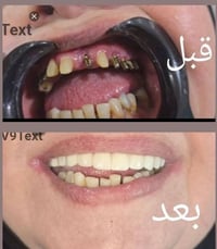 زراعة أسنان • تغليف أسنان • الشطره شارع الأطباء