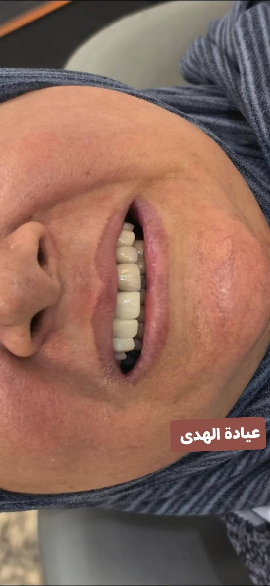 عيادة الهدى لطب الأسنان والتجميل

تقاطع الجدوع مجاور عالم الحليب

***********

اهلا وسهلا بزبائنا الاعزاء

متواجدين يوميا من ٤ عصرا إلى ٩ مساء

نص مكتوب في الصور:
- عيادة الهدى
- BEFORE | قبل AFTER | بعد عيادة الهدى
- BEFORE | قبل
- AFTER | بعد