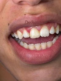 حشوات تجميلية • شغل نظيف • الأمين الثانية