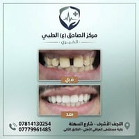 ابتسامة هوليود • تقويم أسنان • النجف الأشرف